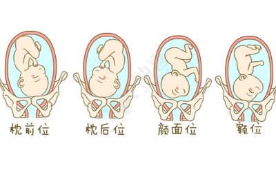 ​右枕前位是什么意思（右枕前位意思解释）