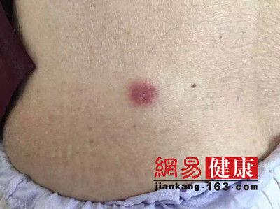 怎样才能检测是被蜱虫咬了(教你辨别是否被蜱虫咬了)(1)