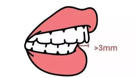 凸嘴整形方法(做好表情管理比化妆修饰效果更好)(25)