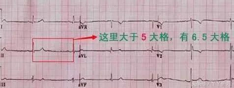 自己怎么看懂心电图（这样教你看心电图）(5)