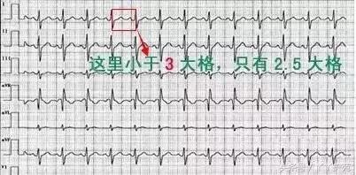 自己怎么看懂心电图（这样教你看心电图）(6)