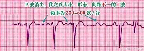 自己怎么看懂心电图（这样教你看心电图）(14)