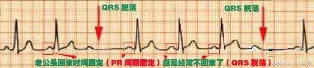 自己怎么看懂心电图（这样教你看心电图）(9)