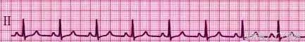 自己怎么看懂心电图（这样教你看心电图）(4)