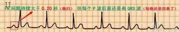 自己怎么看懂心电图（这样教你看心电图）(7)