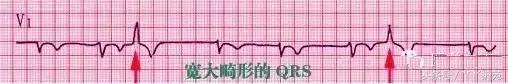 自己怎么看懂心电图（这样教你看心电图）(12)