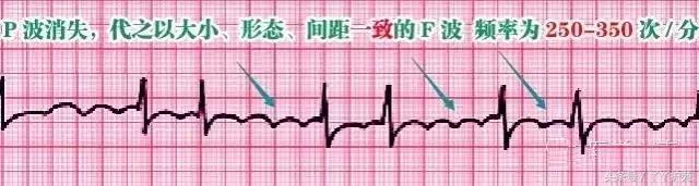 自己怎么看懂心电图（这样教你看心电图）(13)