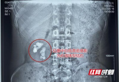 ​肾结石恶化癌变（大叔患肾结石不痛不治）