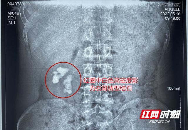 肾结石恶化癌变(大叔患肾结石不痛不治)(1)