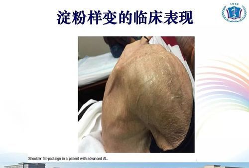 皮肤淀粉样变的症状