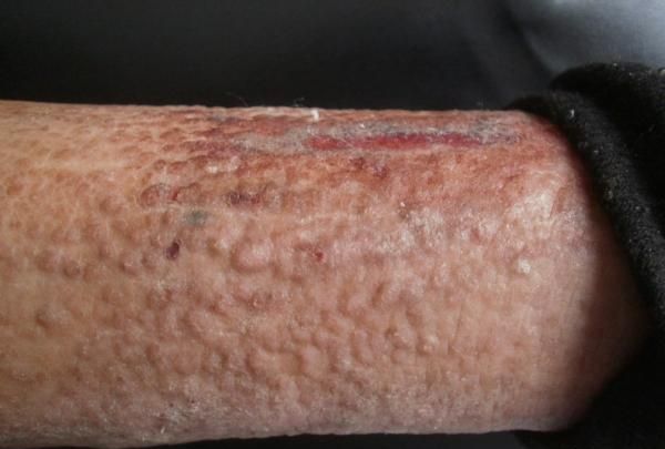 什么是淀粉样变性肾病