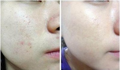 ​脸部毛孔大怎么办简单小妙招？脸部毛孔大怎么办男