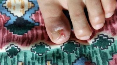 ​脚趾甲往肉里长是怎么回事(脚趾甲往肉里长怎么根治)