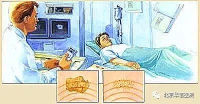 体外冲击波碎石术(小手术大学问体外冲击波碎石术)(3)