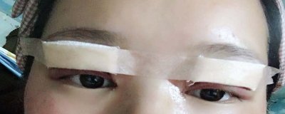 ​眼圈青了怎么快速消除