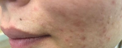 ​冻干粉可以去痘痘吗