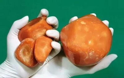 ​得了胆囊结石怎么办如何预防（得了胆囊结石怎么办？）