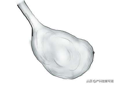 ​卵巢大小 妇科B超报告之卵巢