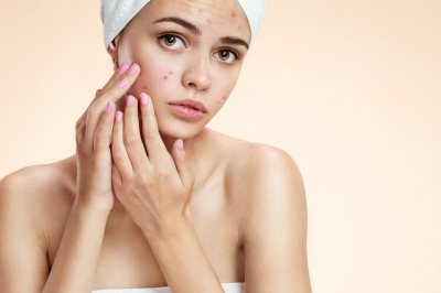 ​痤疮如何治 医生治痤疮常用3种方式，日常做好这2件事，也能拯救你的”痤疮脸”