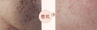 ​去痘疤的简单方法 去痘疤最有效果的方法