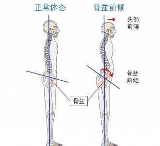 ​骨盆前倾最佳改善动作 骨盆前倾的原因和处理方法