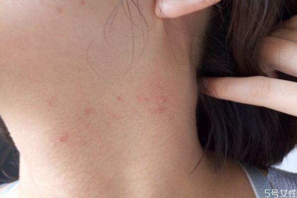 脖子上长痘痘很痛怎么办 脖子上长痘痘怎么调理 脖子上长痘痘很痛怎么办 脖子上长痘痘怎么调理