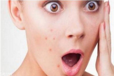 ​熬夜起痘痘能挤吗 熬夜痘痘去除方法