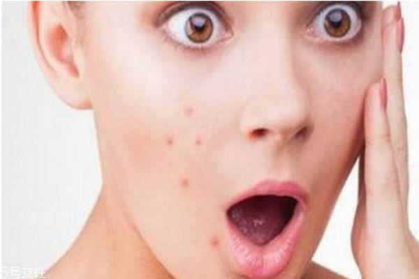 熬夜起痘痘能挤吗 熬夜痘痘去除方法 熬夜起痘痘能挤吗 熬夜痘痘去除方法
