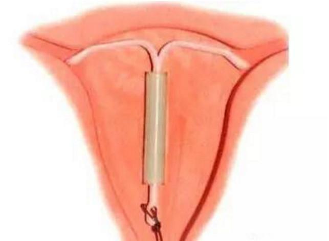 女人在做取环手术的过程是怎么样的, 这个取环过程会不会痛