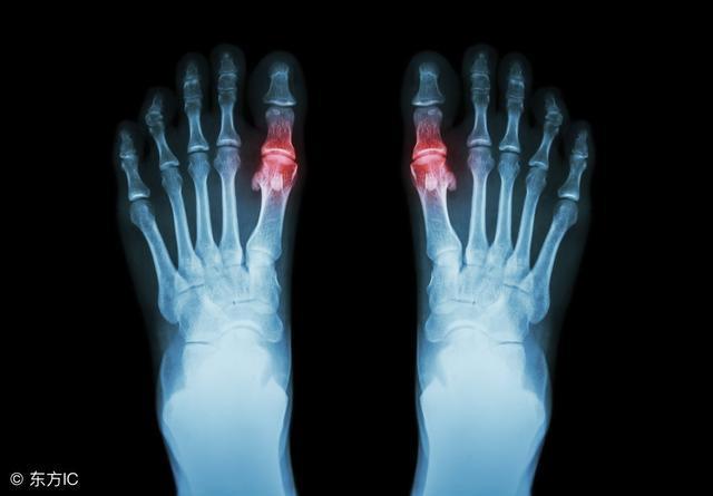 患者自述5年来的痛风降尿酸饮食经验，看完绝对有收获！