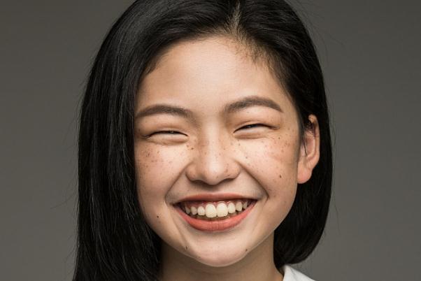 雀斑能点掉不留疤吗 雀斑能做皮秒吗 雀斑能点掉不留疤吗 雀斑能做皮秒吗