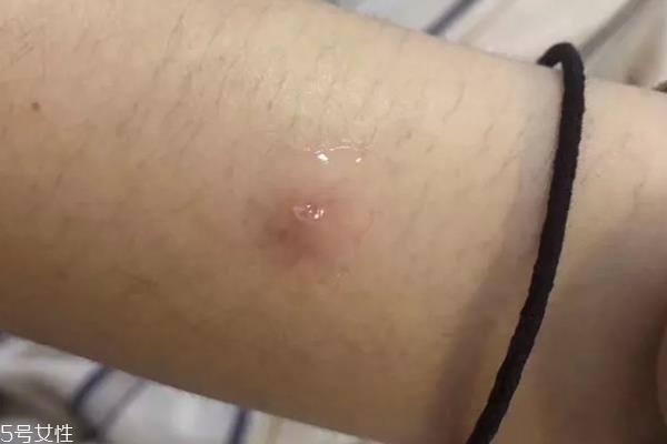 悦木之源祛痘凝胶刺痛什么原因 敏感肌宝宝不适合你