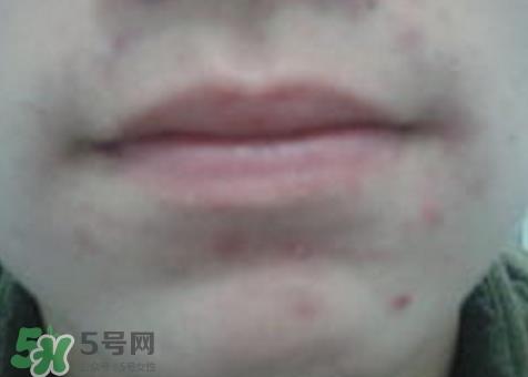 唇周边长痘是什么原因?唇周边长痘是怎么回事? 唇周边长痘是什么原因?唇周边长痘是怎么回事?