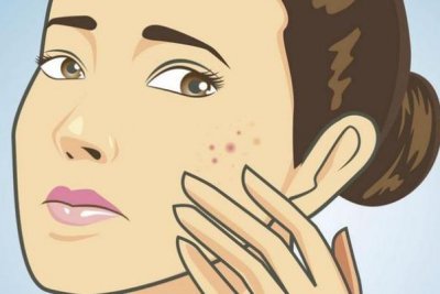 ​痘痘肌肤有哪几种类型 痘痘肌肤有什么特征