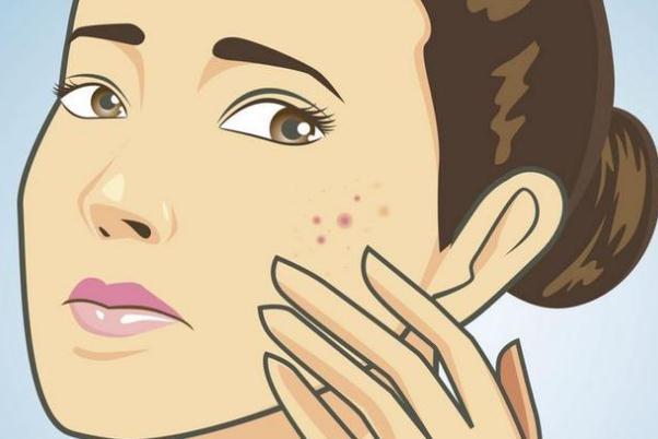 痘痘肌肤有哪几种类型 痘痘肌肤有什么特征 痘痘肌肤有哪几种类型 痘痘肌肤有什么特征