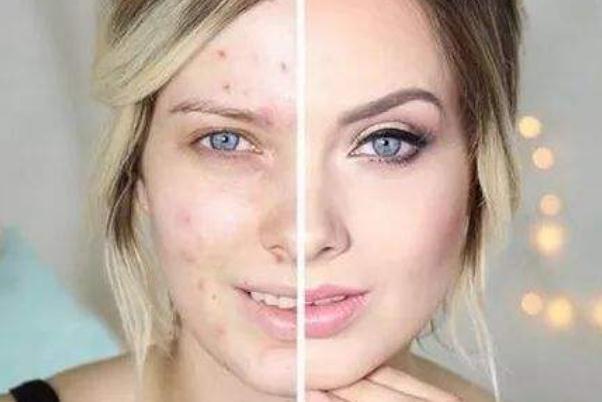 痘痘肌肤有哪几种类型 痘痘肌肤有什么特征 痘痘肌肤有哪几种类型 痘痘肌肤有什么特征