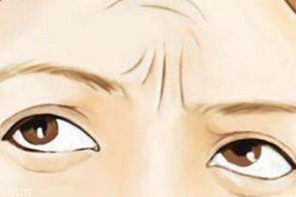 川字纹怎么消除 川字纹是什么 川字纹怎么消除 川字纹是什么