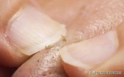 ​MM们快来看看，原来从鼻子挤出的小黄条，竟然是螨虫的粪便？