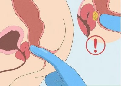 ​如何进行前列腺按摩？