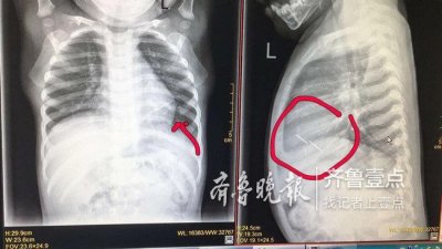 ​惊险！1岁婴儿心脏内扎入一根缝衣针，开胸手术取出
