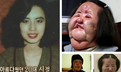 ​“整容狂人”韩慧景：将脸整成电风扇，自行注射大豆油，如今怎样