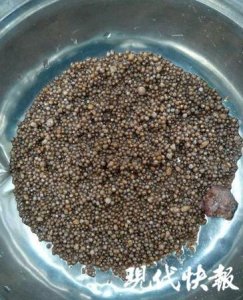 ​医生被吓一跳！56岁大妈右肾2980颗结石不得已切除