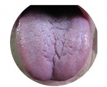 ​裂纹舌是脾胃虚弱的表现！7 种常见裂纹舌，你属于哪一种？