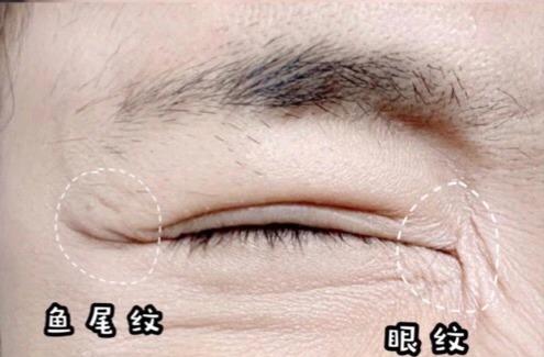 眼部有细纹怎么办5个小妙招解决（眼部细纹很容易出现）(1)