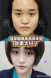 ​玻尿酸隆鼻效果怎么样（玻尿酸隆鼻亲身体验）